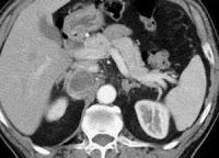 Los Paragangliomas Retroperitoneales Malignos