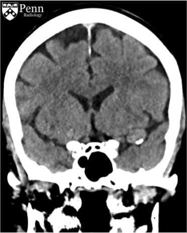 Caso clínico neurología
