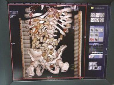 Aduana de Cuba detectó 81 casos de tráfico drogas en 2018 Aduana de Cuba detectó 81 casos de tráfico drogas en 2018