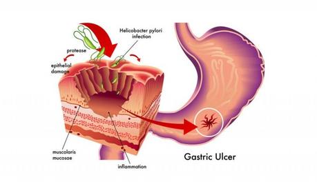 úlcera de estómago