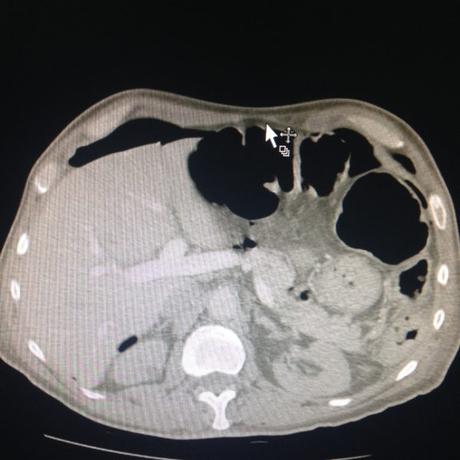 CASO CLINICO DE NEUMOPERITONEO