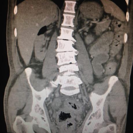 CASO CLINICO DE NEUMOPERITONEO