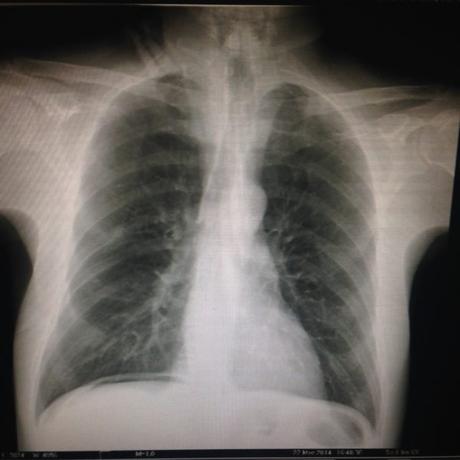 CASO CLINICO DE NEUMOPERITONEO