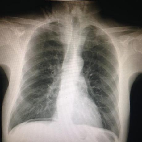 CASO CLINICO DE NEUMOPERITONEO