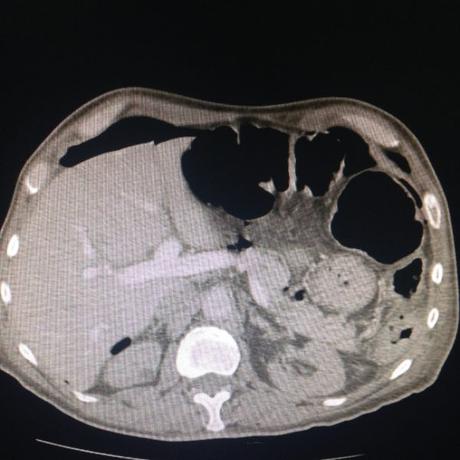 CASO CLINICO DE NEUMOPERITONEO