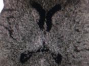 Metastasis craneo adenocarcinoma mama