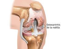La Terapia Hormonal es lo mejor para Tratar la Osteoartritis de Rodilla