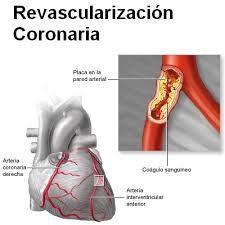 Revascularización en el IAM con elevación ST