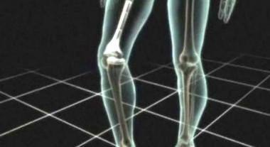 Artricenter: ¿Cómo afecta la artritis reumatoide a los huesos?