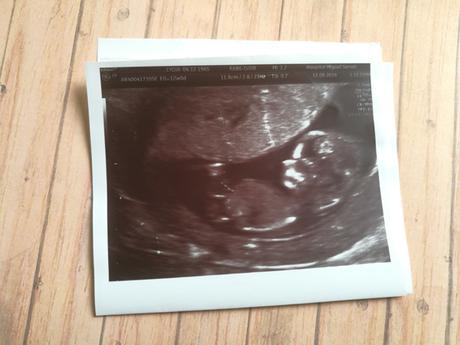 Más ecografías durante el embarazo ¿Son necesarias?