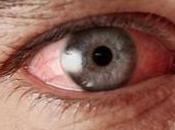Sarcoidosis