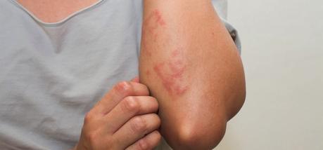 Sarcoidosis Síntomas de la sarcoidosis