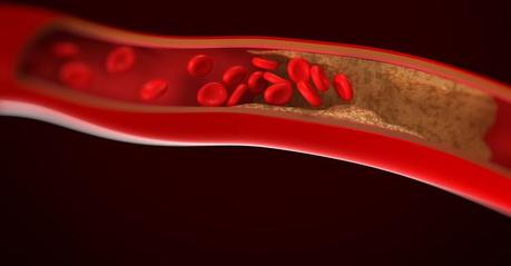 ¿Cómo prevenir la arteriosclerosis?
