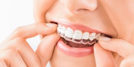 Las ventajas de la ortodoncia invisalign