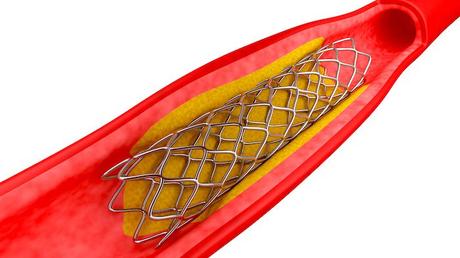 ¿Qué es un stent? Todo lo que necesitas saber ¿Qué es un stent? Todo lo que necesitas saber