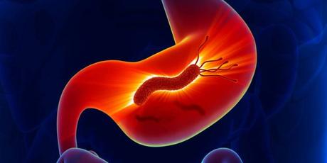 Helicobacter Pylori – Todos los tratamientos disponibles Helicobacter Pylori – Todos los tratamientos disponibles