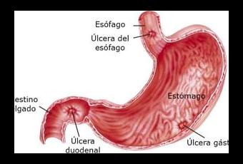 como eliminar halitosis como eliminar halitosis