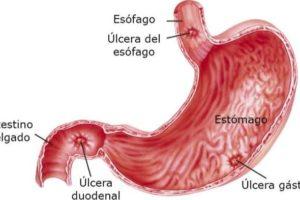úlcera gastroduodenal | Todo lo que debes saber