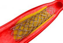 ¿Qué es un stent? Todo lo que necesitas saber