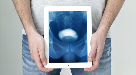 Cáncer de vejiga: lo que debe saber sobre el tratamiento con BCG Cáncer de vejiga: lo que debe saber sobre el tratamiento con BCG