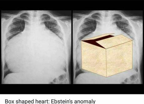 caja en forma de corazón anomalía de ebstein bart