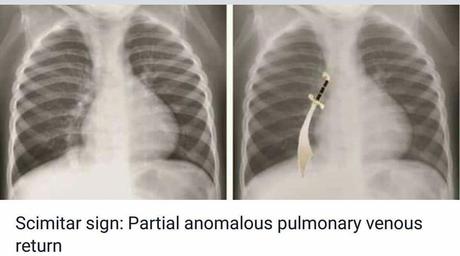 Signo de cimitarra: retorno venoso pulmonar parcial anómalo