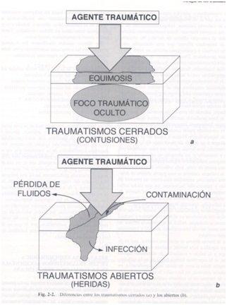 Concepto y clasificación de los traumatismos. Contusiones. Síndrome de la onda expansiva. Síndrome de aplastamiento.