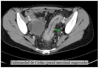 Anatomía radiológica del peritoneo y tubo digestivo