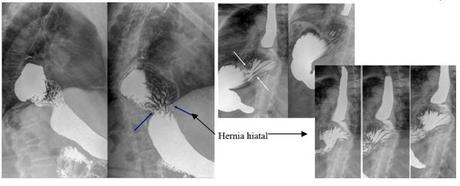 Anatomía radiológica del peritoneo y tubo digestivo