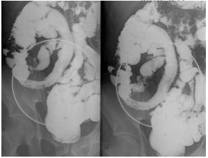 Anatomía radiológica del peritoneo y tubo digestivo