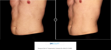 ¿SE PUEDE POTENCIAR EL MUSCULO SIN HACER EJERCICIO? AHORA SI CON LA NUEVA TECNOLOGIA HIFEM ¿SE PUEDE POTENCIAR EL MUSCULO SIN HACER EJERCICIO? AHORA SI CON LA NUEVA TECNOLOGIA HIFEM