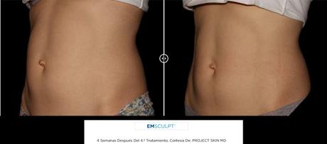 ¿SE PUEDE POTENCIAR EL MUSCULO SIN HACER EJERCICIO? AHORA SI CON LA NUEVA TECNOLOGIA HIFEM ¿SE PUEDE POTENCIAR EL MUSCULO SIN HACER EJERCICIO? AHORA SI CON LA NUEVA TECNOLOGIA HIFEM