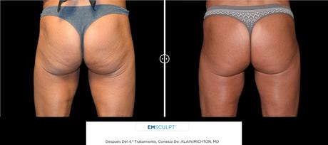 ¿SE PUEDE POTENCIAR EL MUSCULO SIN HACER EJERCICIO? AHORA SI CON LA NUEVA TECNOLOGIA HIFEM ¿SE PUEDE POTENCIAR EL MUSCULO SIN HACER EJERCICIO? AHORA SI CON LA NUEVA TECNOLOGIA HIFEM