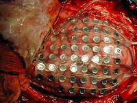 La Cirugía de la Epilepsia suele ser el Recurso Poco Utilizado