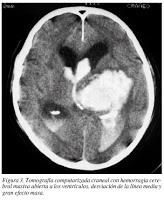 Objetivos Quirúrgicos para el Tratar una Hemorragia intracerebral