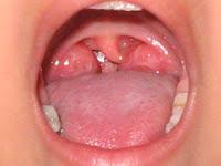 Actualizan las Pautas para la Realización de una Amigdalectomía