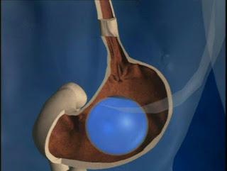 BALON INTRAGASTRICO: Te explicamos por qué esta técnica sigue siendo de las principales para tratar el sobrepeso
