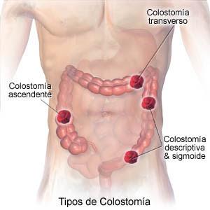 EL TENER UNA VIDA PLENA Y ACTIVA DEPENDE DEL PACIENTE NO DE LA OSTOMÍA