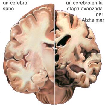 El citoesqueleto de las neuronas está implicado en la enfermedad de Alzheimer.