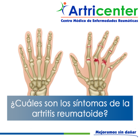 Artricenter: ¿Cuáles son los síntomas de la artritis reumatoide?