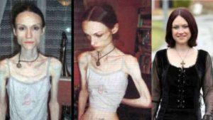 6 Personas Han Aprendido A Superan La Anorexia Así: