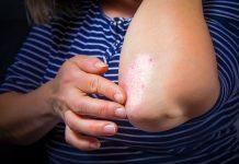 ¿Por qué la psoriasis aumenta el riesgo de diabetes? Un estudio reciente exploró los vínculos moleculares entre la psoriasis y la diabetes