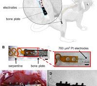 Placas óseas Inteligentes pueden controlar la curación de Fracturas