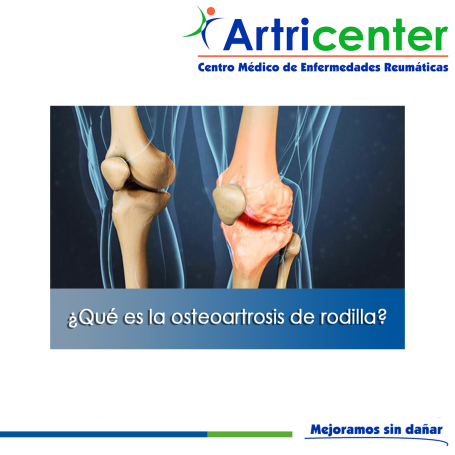Artricenter: ¿Qué es la osteoartrosis de rodilla?
