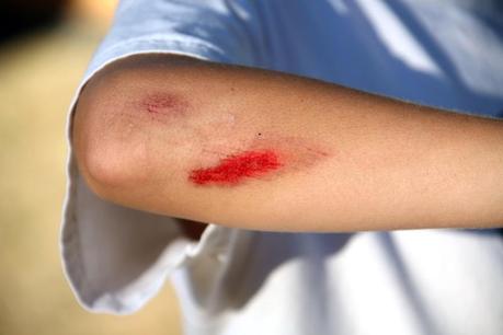 Cómo saber si una herida está infectada y cómo curarla