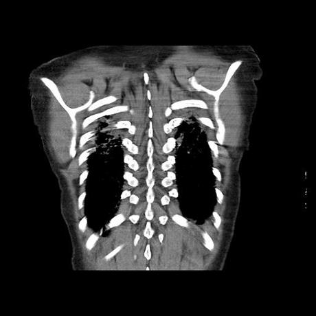 NEUMOPATIA INTERSTICIAL PROBABLE ETIOLOGIA HIPERSENSITIVA VS AUTOINMUNE/BACTERIANA/FUNGICA.