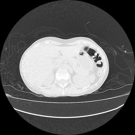 NEUMOPATIA INTERSTICIAL PROBABLE ETIOLOGIA HIPERSENSITIVA VS AUTOINMUNE/BACTERIANA/FUNGICA.