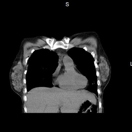 NEUMOPATIA INTERSTICIAL PROBABLE ETIOLOGIA HIPERSENSITIVA VS AUTOINMUNE/BACTERIANA/FUNGICA.