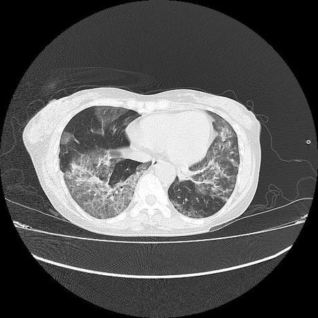 NEUMOPATIA INTERSTICIAL PROBABLE ETIOLOGIA HIPERSENSITIVA VS AUTOINMUNE/BACTERIANA/FUNGICA.