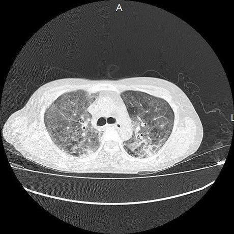 NEUMOPATIA INTERSTICIAL PROBABLE ETIOLOGIA HIPERSENSITIVA VS AUTOINMUNE/BACTERIANA/FUNGICA.